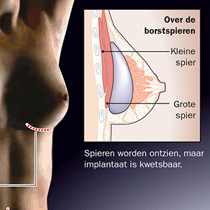 Breast implant