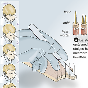 Hair transplant