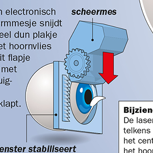 Refractive surgery