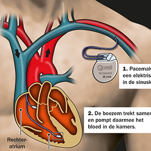 Pacemaker